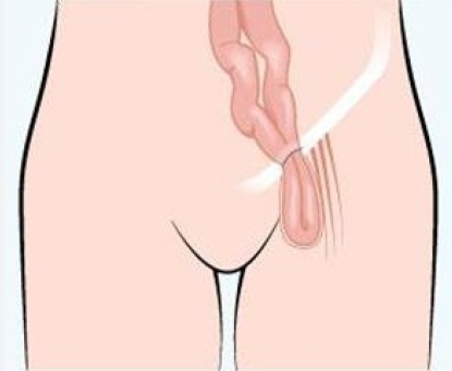 Tổng quan bệnh thoát vị đùi